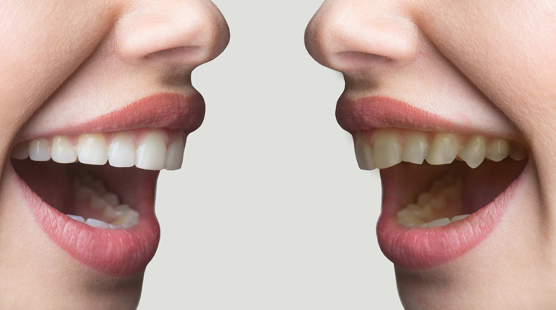 Side by Side teeth comparison