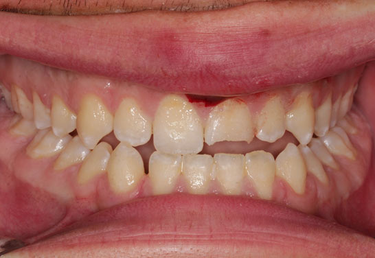 Dental Bridge Before