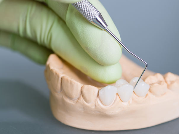 Large Model of Dental Bridges