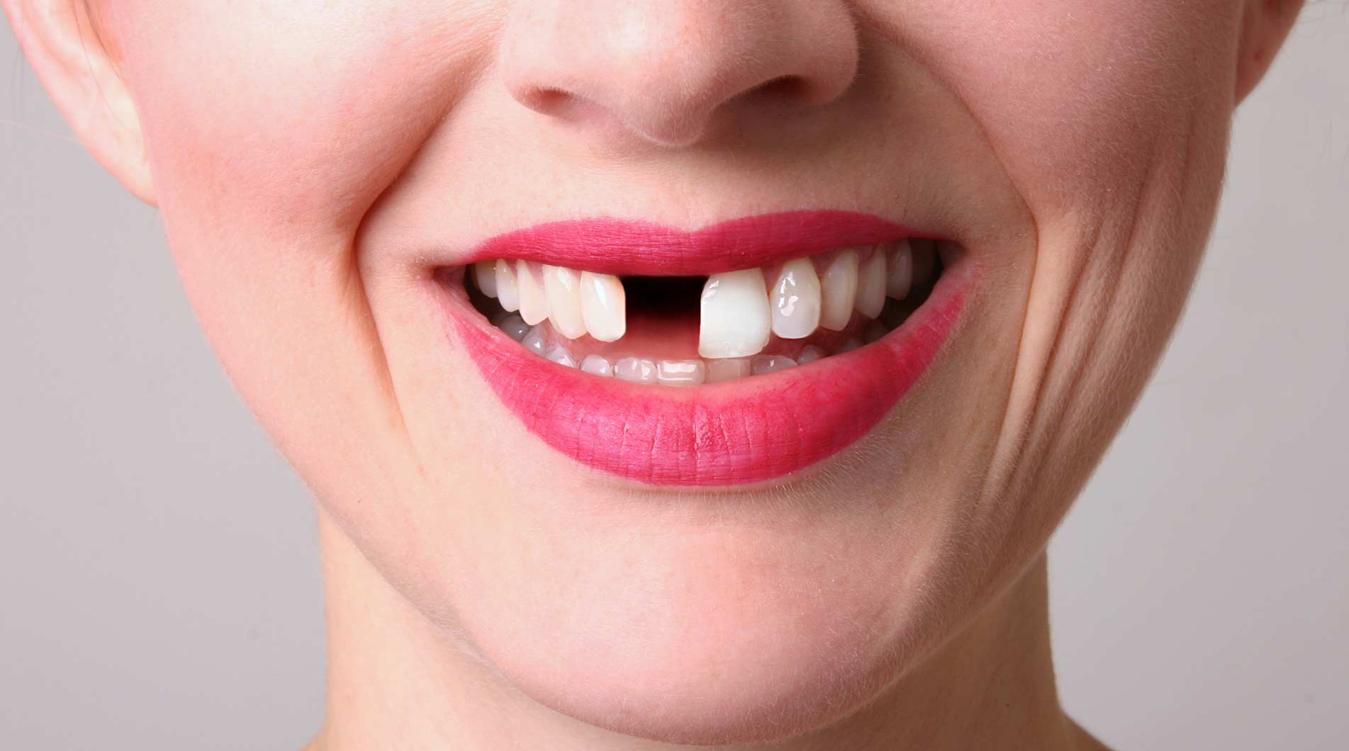 Fix your missing teeth at Dental at Joondalup