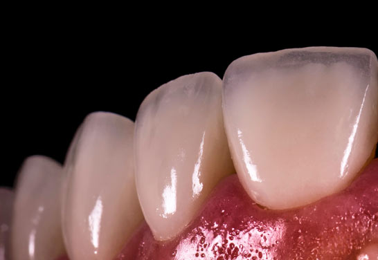 After Porcelin veneers