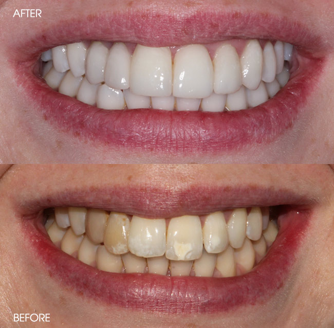 Dental at Joondalup Veneers Before and After 2