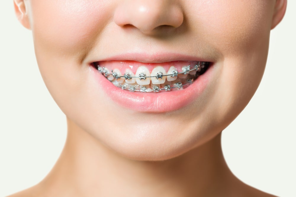 dental braces