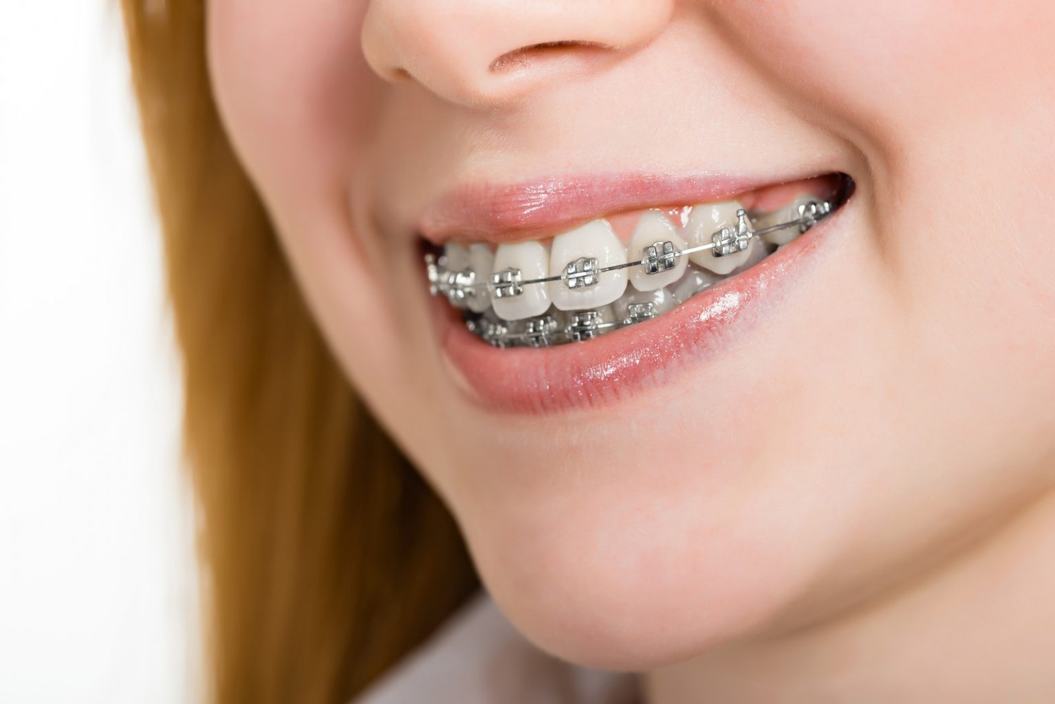 types of materials used in braces 1534x1024