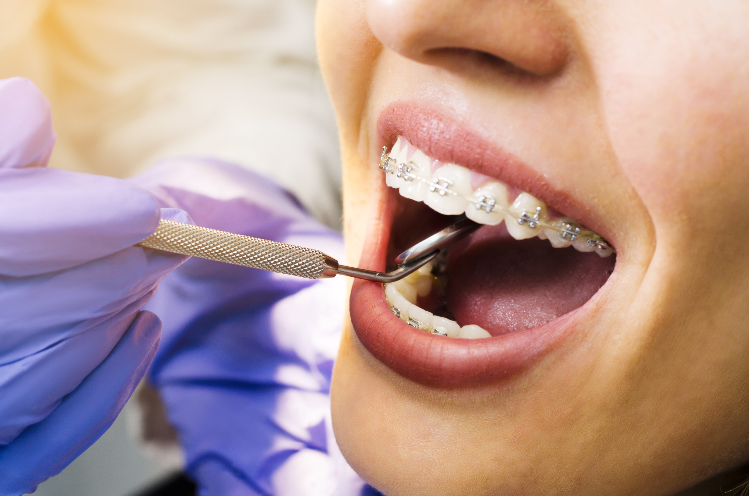 braces procedure min (1)